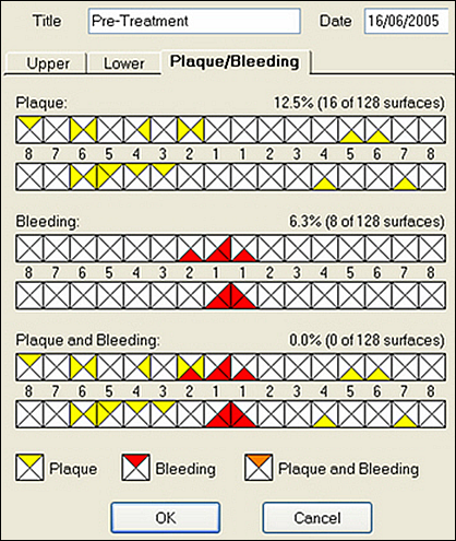 PopulatedPlaque-Bleeding